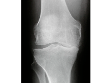 Diagnóstico da artrose da articulación do xeonllo