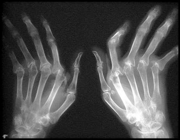 Imaxe x -ray das mans afectadas pola artrose