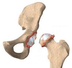 As razóns para o desenvolvemento da artrose da articulación da cadeira