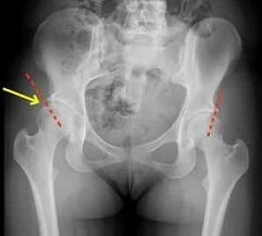 Métodos para o tratamento da artrose da articulación da cadeira