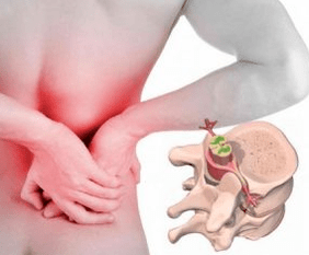 Lumbago ao comezo da enfermidade osteocondrose
