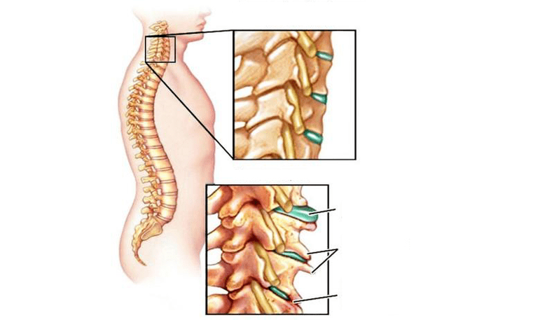 Síndromes de osteocondrosis