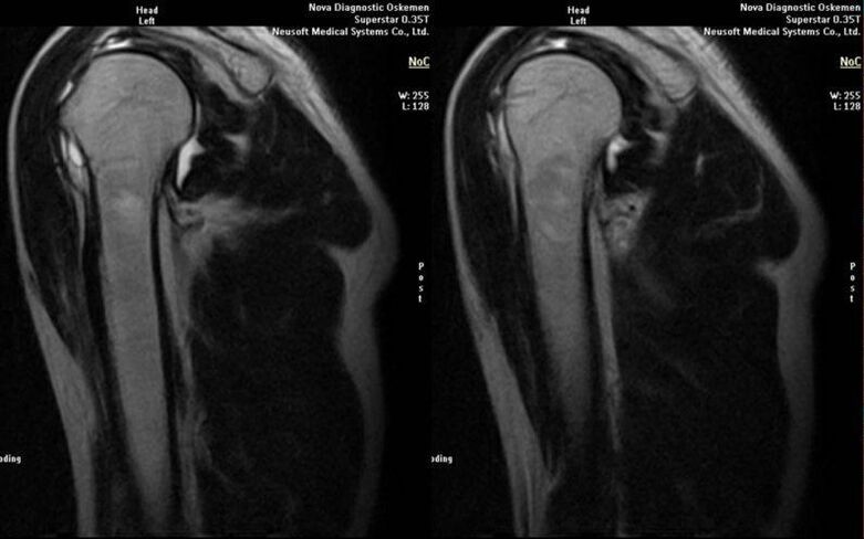 artrose da articulación do ombreiro na radiografía